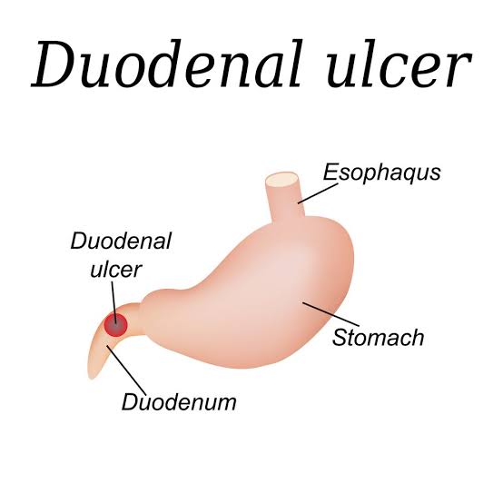 Duodenal ulcers 