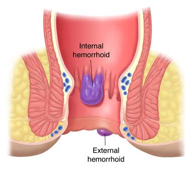Internal hemorrhoids 