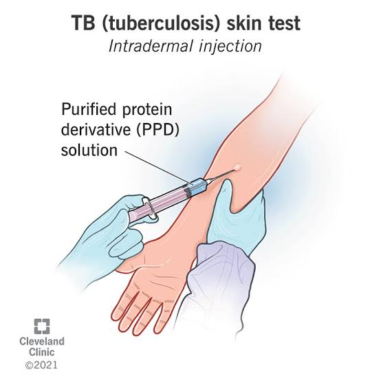 Tuberculin skin test