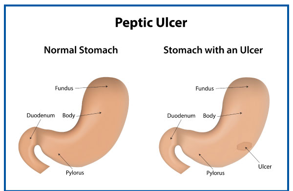 Peptic ulcers 