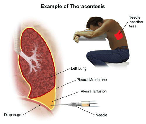 thoracentesis