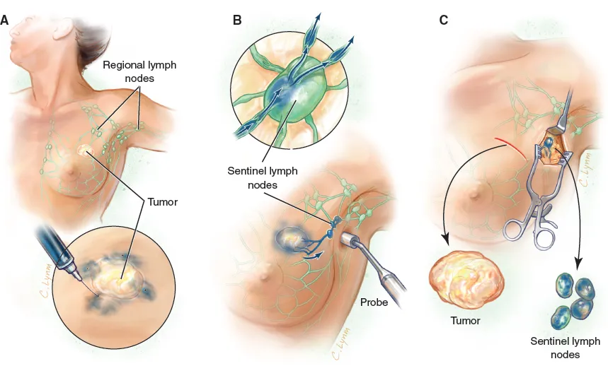 sentinel lymph nodes biopsy