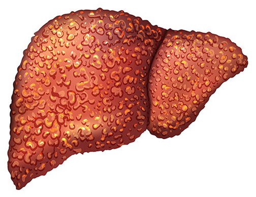 liver cirrhosis