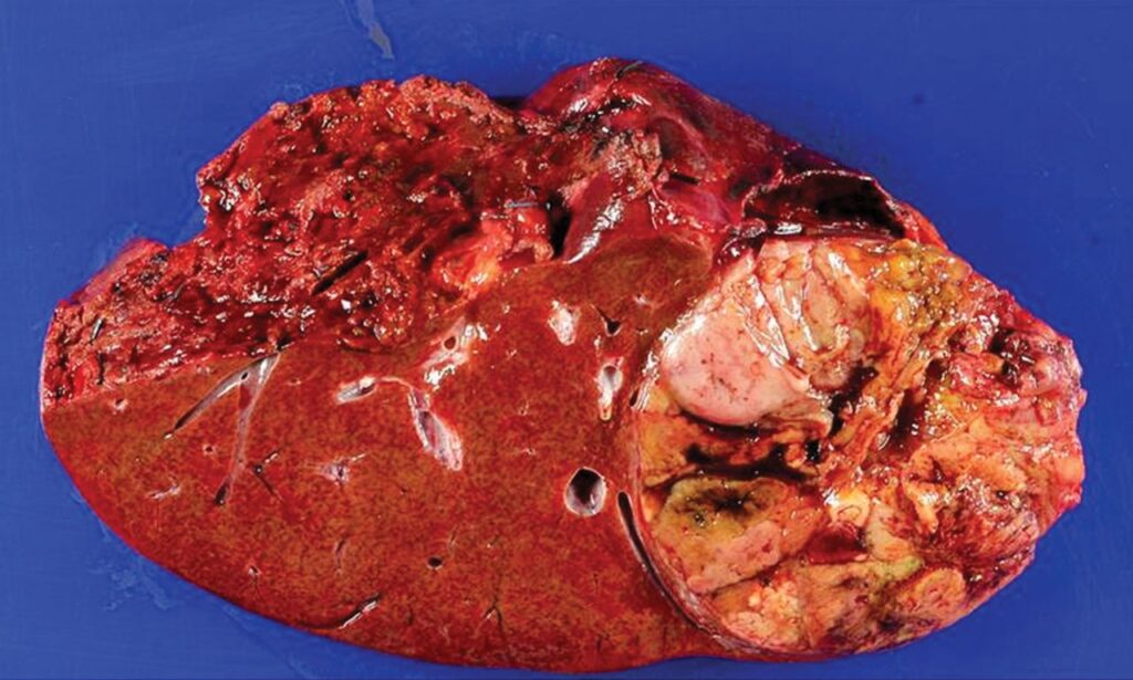 hepatoma