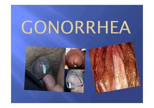  Gonorrhea