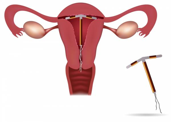 intrauterine contraceptive device