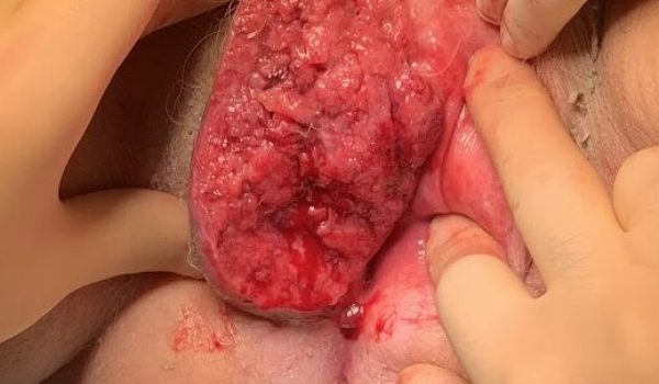 vulvar cancer 