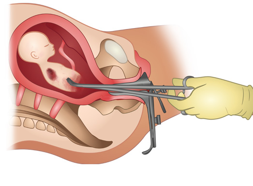 surgical abortion