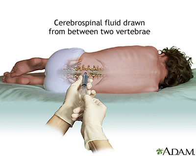 umbar puncture for cerebrospinal fluid analysis