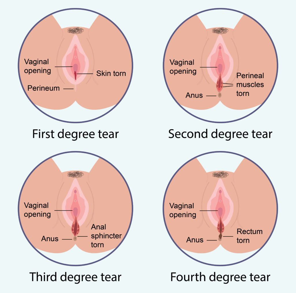 perineal tear degrees