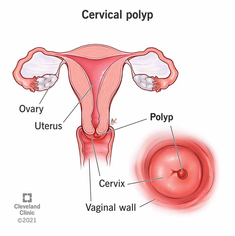 cervical polyps