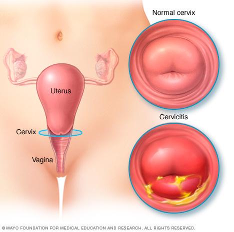 cervicitis