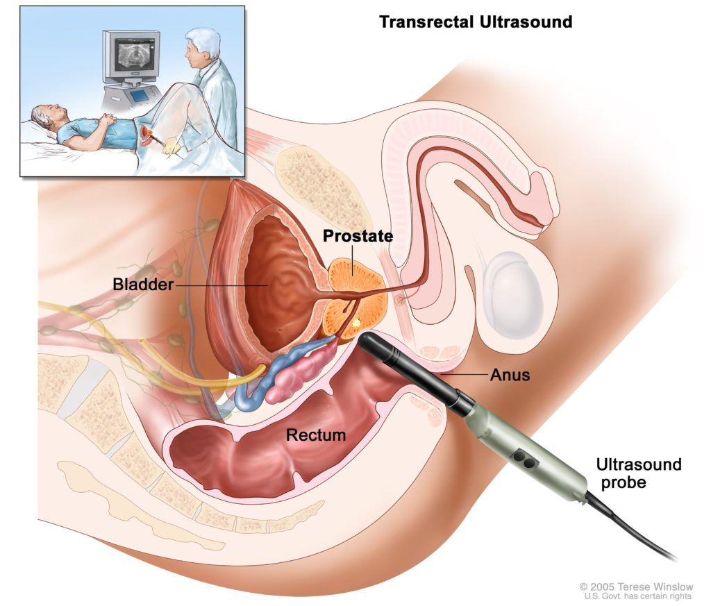 Transrectal Ultrasound (TRUS)