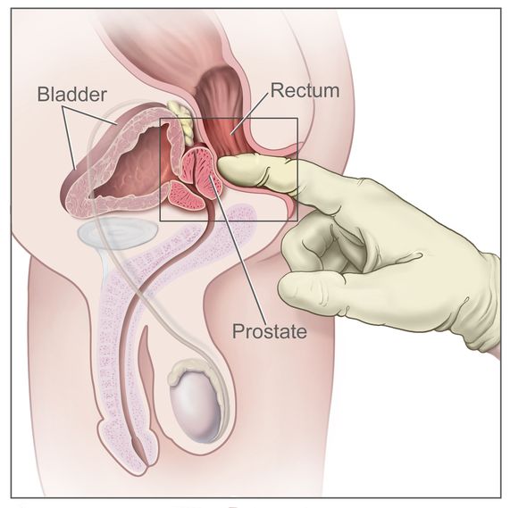 Digital Rectal Examination (DRE)