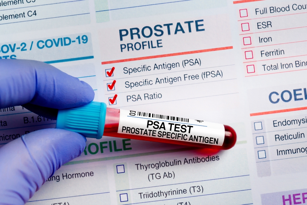 Prostate-Specific Antigen (PSA)