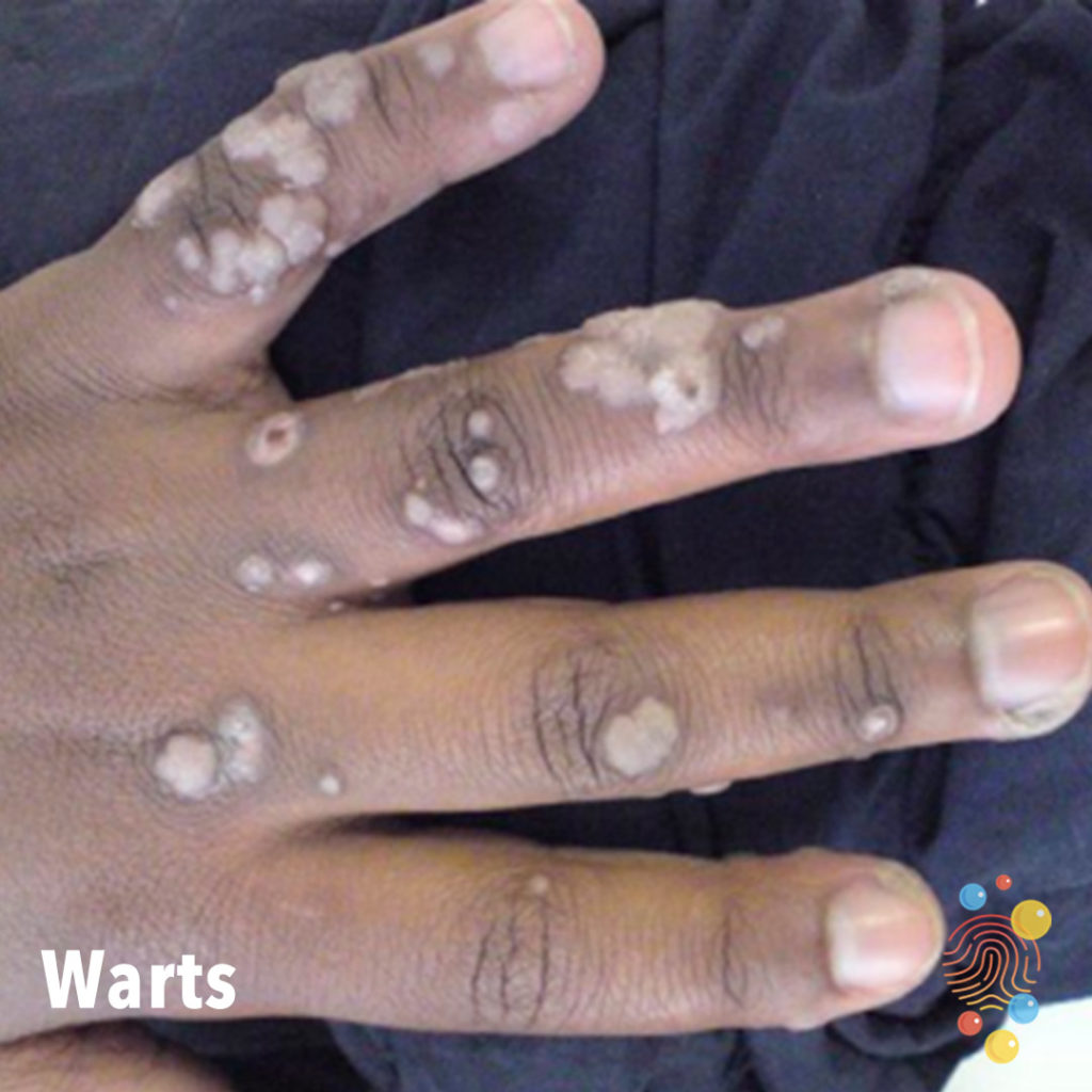 common warts