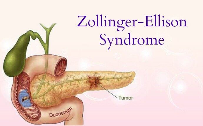 Zollinger-Ellison syndrome