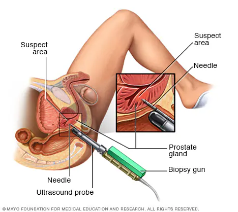 Prostate Biopsy