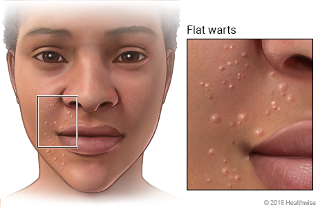 flat warts