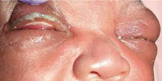 gonococcal conjuctivitis