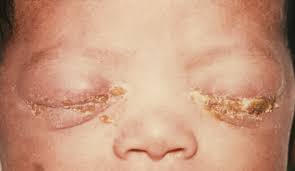 neonatal conjuctivitis