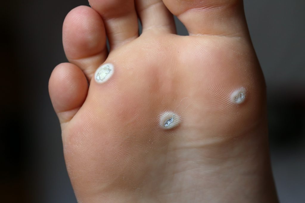 plantar warts/