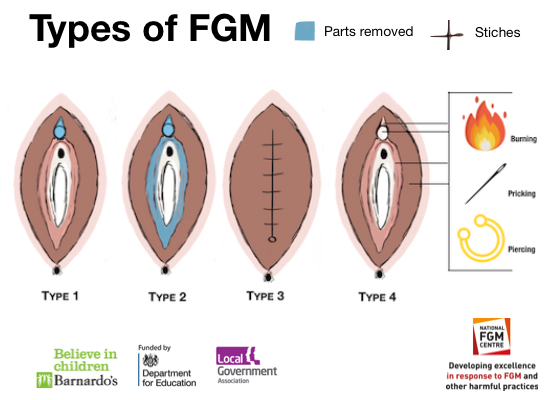 fgm