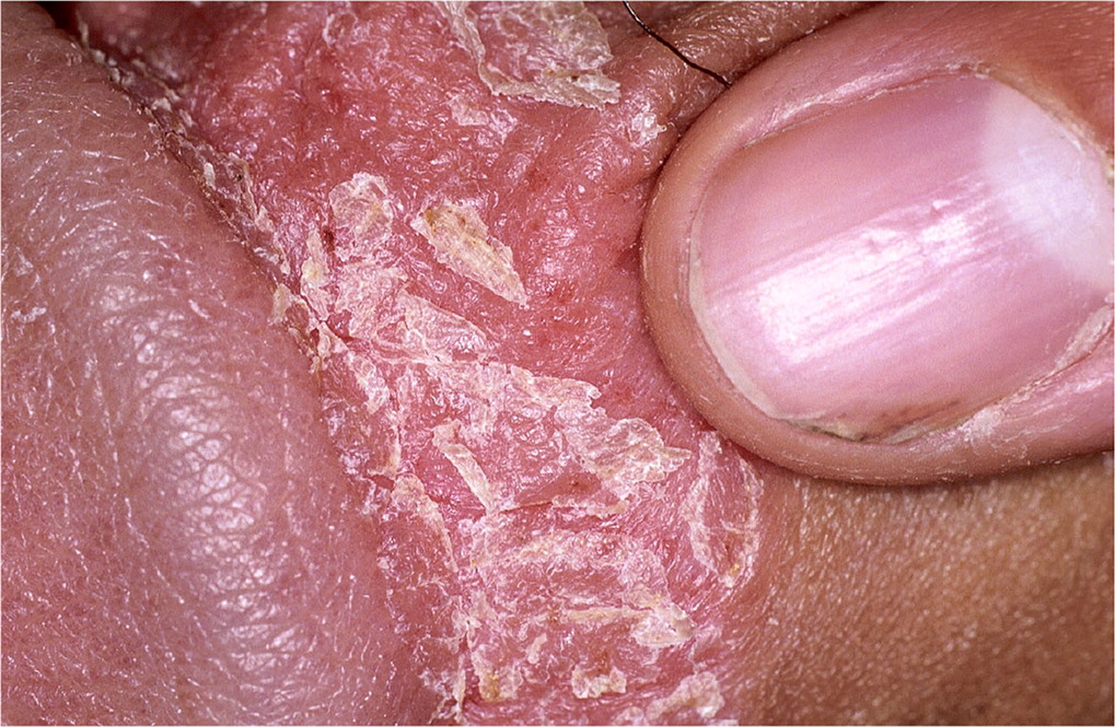 psoriasis