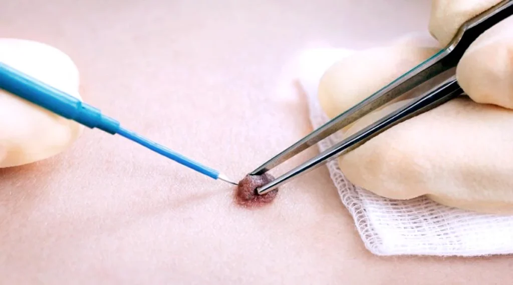 Electrocautery/Laser Therapy