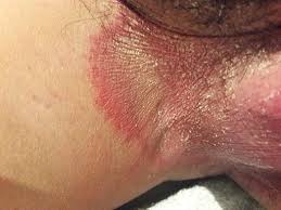 Tinea Cruris (Jock Itch)