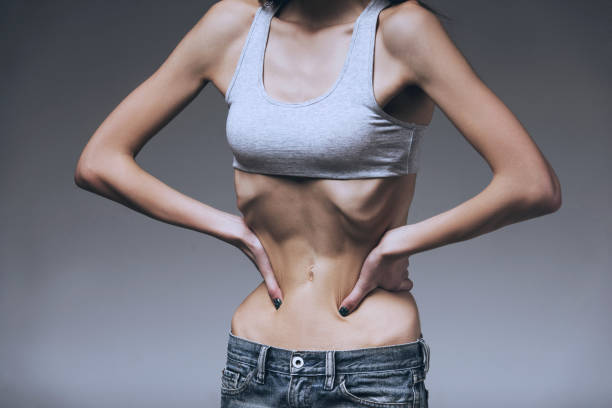 Anorexia nervosa
