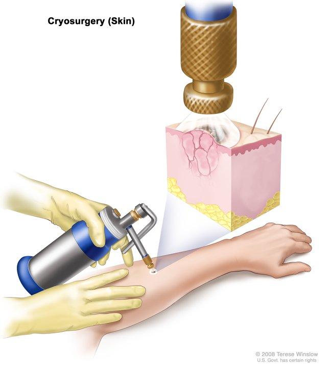 Cryotherapy