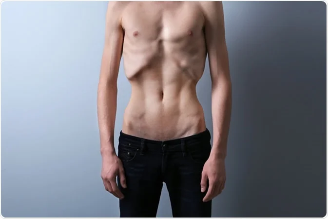 anorexic man