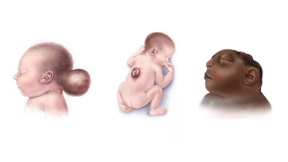 kasoro za neva kwa mtoto (neural tube defects)