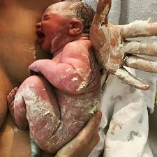 vernix caseosa